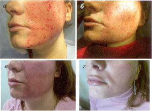 etapy odbudowy skóry po zabiegu ablacji frakcyjnej