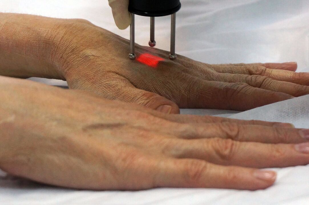 Laserowe odmładzanie dłoni metodą nieablacyjną