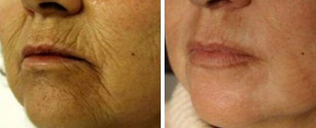 Rejuvenation 4d