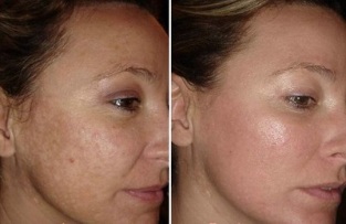 laserowe odmładzanie skóry twarzy zdjęcia przed i po